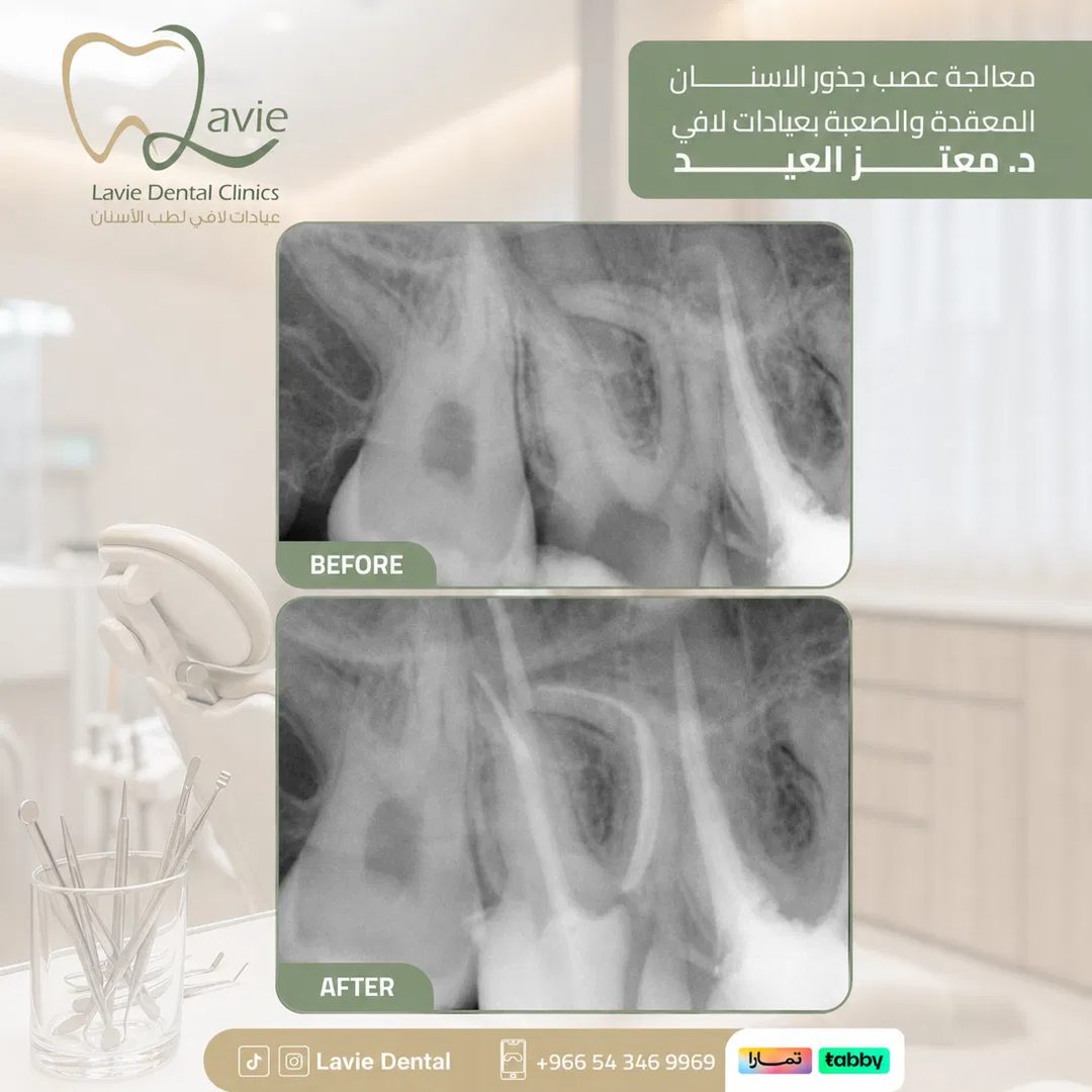 Complex Root Canal before and after, Dr. Moataz Al-Eid, Lavie Riyadh