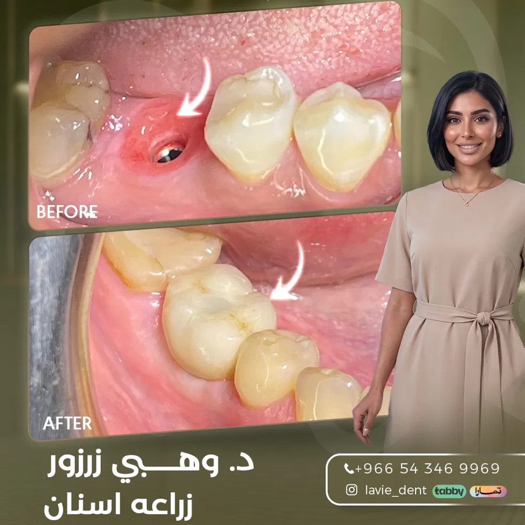 Dental Implants before and after, Dr. Wahbi Zarzour, Lavie Riyadh