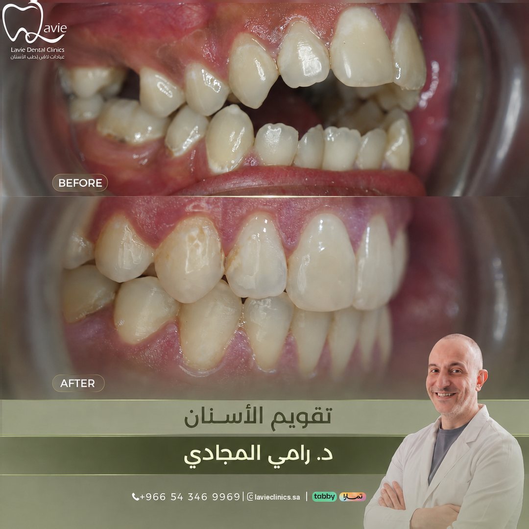 Orthodontics before and after, Dr. Rami Al-Majadi, Lavie Riyadh