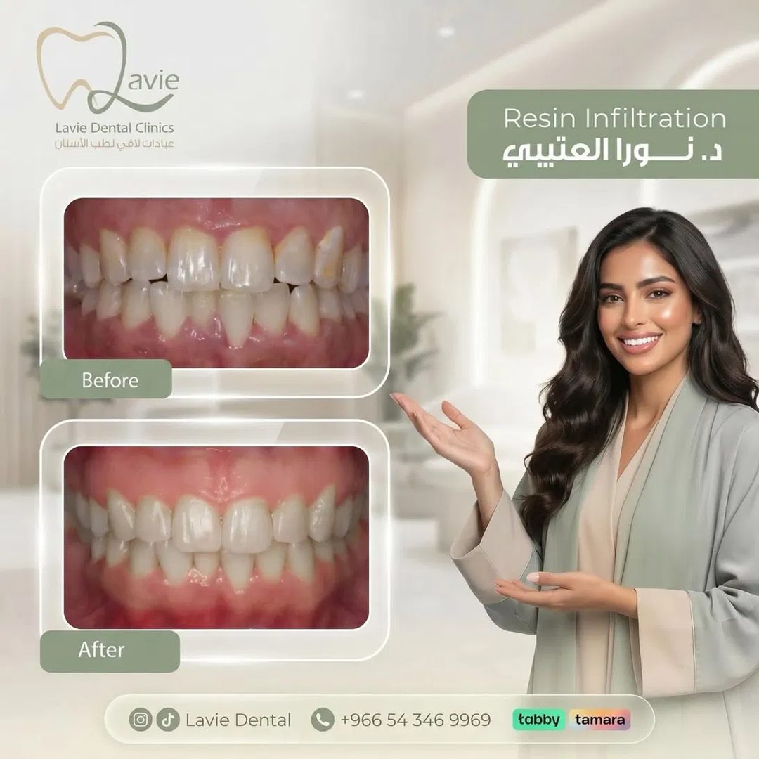 Resin Infiltration before and after, Dr. Noora Al-Otaibi, Lavie Riyadh