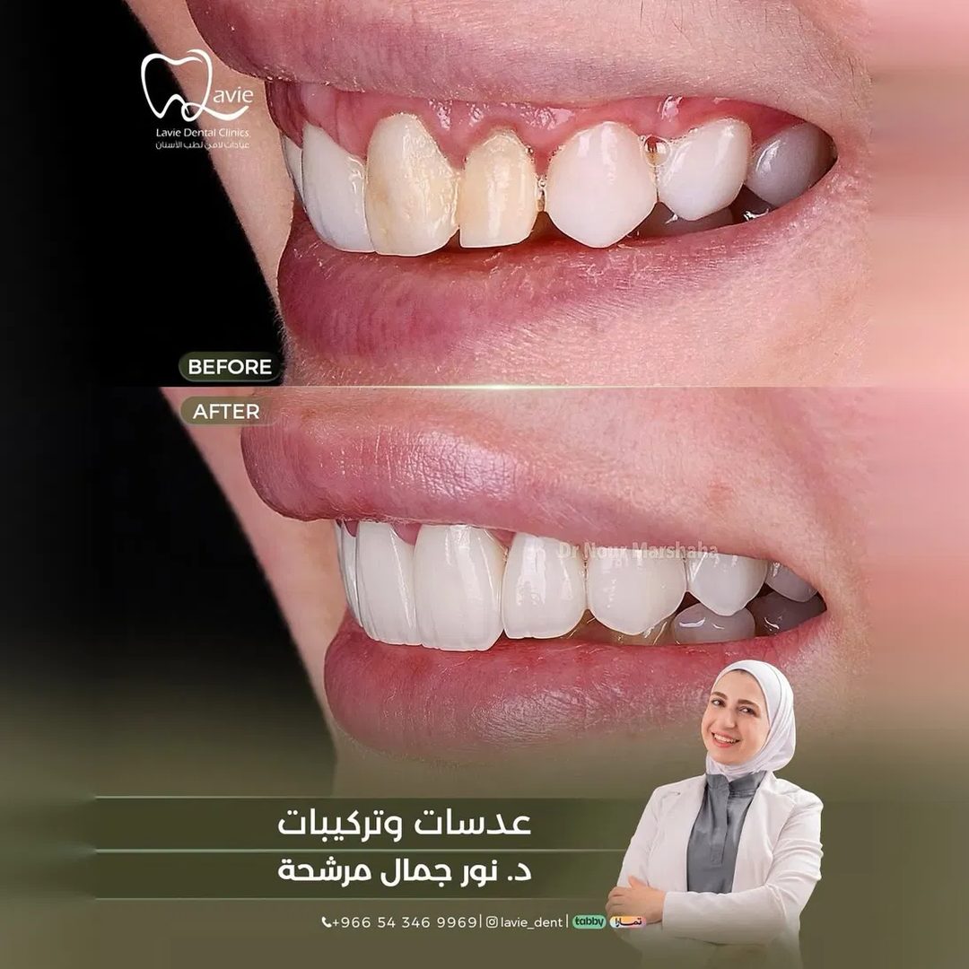 Veneers & Prosthetics before and after, Dr. Noor Jamal Mershah, Lavie Riyadh