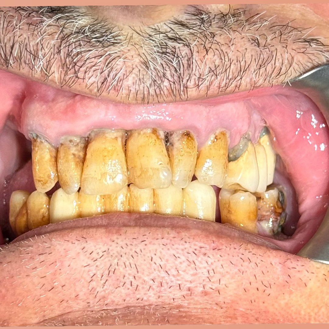 Before — Dr. Wahbi Zarzour